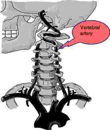 The vertebral artery wending its way around the atlanto occipital joint. Whiplash Injury, Vertebral Artery, Whiplash, The Skull, Chiropractic, The Head, A Horse, Natural Remedies, Humanoid Sketch