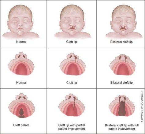 Midwifery Student, Cleft Lip And Palate, Cleft Palate, Student Midwife, Cleft Lip, Medical Missions, Ob Nursing, Neonatal Nurse, Oral Surgeon