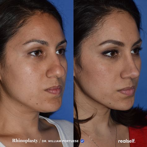 The term bulbous nose refers to an enlarged tip of the nose. Long Nose Rhinoplasty, Bulbous Nose Job, Nose Job Bulbous Tip, Nose Job Before And After Bulbous, Rhinoplasty Before And After Bulbous, Bulbous Tip Rhinoplasty, Bulbous Nose Rhinoplasty Before After, Nose Job Before And After, Ethnic Nose Job