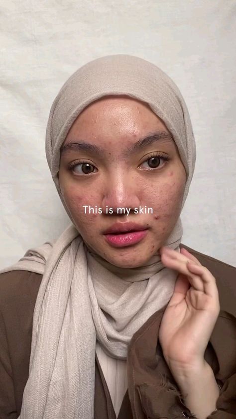 do you get rid of acne then you need this [ visit link ] for more.. Acne Insecurities, Acne Is Beautiful, Pretty People With Acne, Acne Pretty, Acne Girl, Cetaphil Acne, Acne Aesthetic, Treat Hormonal Acne, Dark Joke