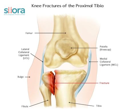 Knee Fractures Knee Fracture, Leg Bones, Surgery, The Knee, Acting, Bones