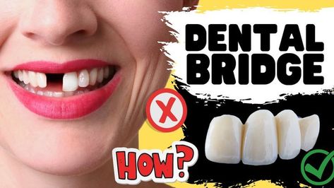 "In this tooth bridge video, Dr. Sami reviews what is a dental bridge. What is the difference between a tooth bridge and a dental implant? How long does the dental bridge procedure take? How much does a dental bridge cost? How does the bridge replace missing teeth? Is a dental bridge safe? will a dental bridge look good on my front teeth? All these questions will be answered." ~Smile Influencers Dental Bridge Front Teeth, Tooth Bridge, Dental Bridge Cost, Teeth Whitening Remedies, Front Teeth, Missing Teeth, Dental Bridge, Gold Teeth, Receding Gums