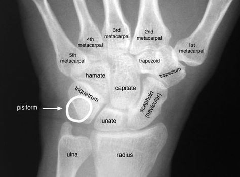 Radiographic Anatomy of the Skeleton: Wrist -- Posteroterior (PA) View, Labelled Geriatric Occupational Therapy, Radiology Student, Physical Therapist Assistant, Yoga Anatomy, Rad Tech, Human Anatomy And Physiology, Hand Therapy, X Rays, Medical Anatomy