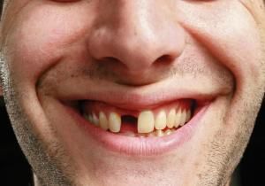 Scientists have used stem cells derived from urine to grow teeth, according to a study published in the journal Cell Regeneration. Missing Tooth, Bells Palsy, Partial Dentures, Human Teeth, Tooth Replacement, Missing Teeth, Teeth Implants, Dental Bridge, Neurological Disorders