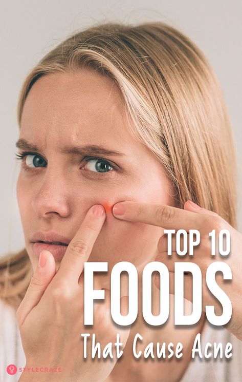 Top 10 Foods That Cause Acne Nodule Acne, Acne Causing Foods, Treating Cystic Acne, Foods For Clear Skin, Food That Causes Inflammation, Lotion For Oily Skin, Tips For Oily Skin, Hormonal Imbalance, Natural Acne