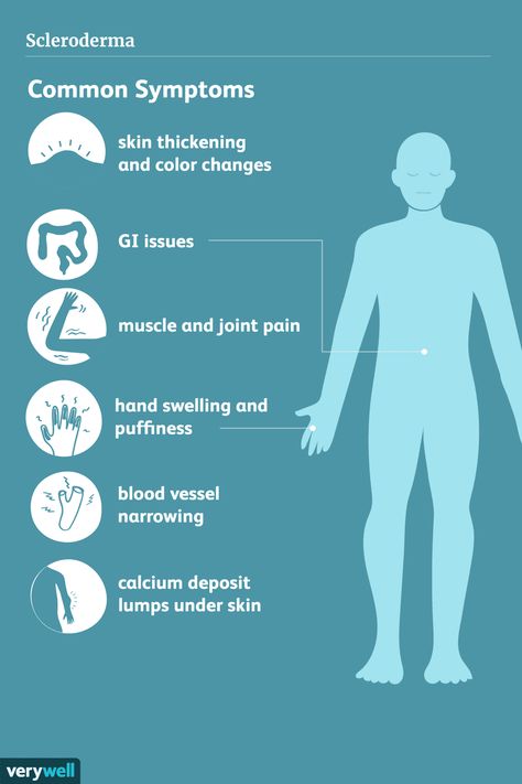 Scleroderma Symptoms, Swollen Hands, Scleroderma Awareness, Thyroid Healing, Sjogrens Syndrome, Digestive Issues, Skin Dryness, Chronic Inflammation, Muscle Pain