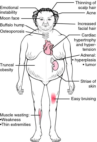 Cushing's syndrome - definition of Cushing's syndrome in the Medical dictionary - by the Free Online Medical Dictionary, Thesaurus and Encyc... Cushing Syndrome, Cushing’s Syndrome, Cushings Disease, Adrenal Cortex, Cushings Syndrome, Medical Dictionary, Addisons Disease, Endocrine Disorders, Nursing School Survival