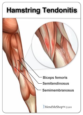 Tendinopathy of the Hamstring Hamstrings Anatomy, Stiff Hamstrings, Hamstring Injury, Stretches For Hamstring Injury, Proximal Hamstring Tendinopathy Exercises, Muscle Belly, Soft Tissue Injury, Referred Pain, Calf Cramps