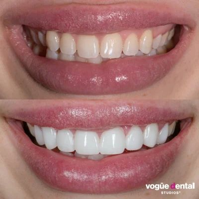 Before and after images for treatments such as porcelain veneers, Invisalign Lite, Invisalign Full, teeth whitening, and gum laser surgery, Teeth Whitening Before And After, Invisalign Before And After, Veneers Before And After, Veneer Teeth, Natural Veneers, Veneers Teeth, Laser Surgery, Porcelain Veneers, General Dentistry