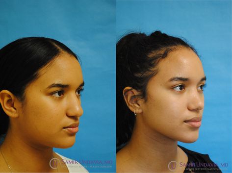 This 6 month before and after result of rhinoplasty shows a smaller lifted nose with a gentle curve that doesn't droop while smiling and fits her face much more. Face Lift Before And After, Face Plastic Surgery, Nose Surgery, Face Lift, Plastic Surgery, Surgery, Take That, Human, Quick Saves