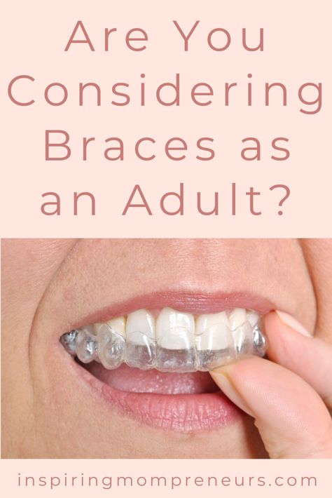 One in every five individuals past adolescence takes steps to correct their misaligned teeth.  Most prefer discreet aligners.    Fortunately, braces have come a long way.  Read on...   #clearbraces #modernbraces #orthodontics #modernorthodontics #aligners Teeth Correction, Lingual Braces, Ceramic Braces, Misaligned Teeth, Teeth Alignment, Clear Braces, Crooked Teeth, False Teeth, Metal Braces