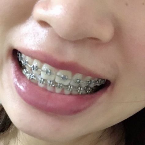 Gray Braces Teeth, Perfect Teeth Braces, Aesthetic Vision Board Pictures, Braces And Glasses, Braces Food, Silver Braces, Cute Braces Colors, Teeth Aesthetic, Aesthetic Vision Board