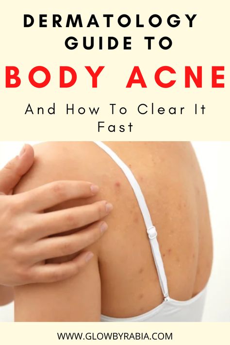 If you want to know what causes back acne and how you can prevent and treat it at home, we're sharing our best tips and remedies that really work! How To Treat Back Acne, Back Acne Causes, Back Acne Remedies, Cerave Moisturizing Lotion, Acne Body Wash, Back Acne, Exfoliating Body Wash, Bumpy Skin, Acne Cleansers