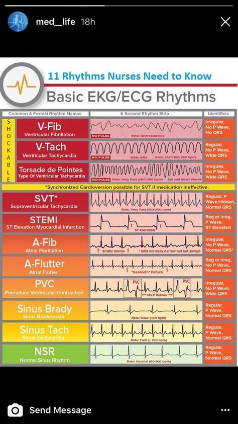 Different types of heart rhythms Room Basic, Paramedic School, Nursing Cheat, Nursing Mnemonics, Nursing Student Tips, Cardiac Nursing, Medical Student Study, Nursing School Survival, Critical Care Nursing