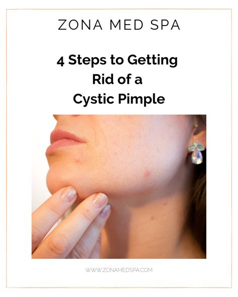 Deep Pimple, Cystic Pimple, Hydrocortisone Cream, Beauty App, Skincare Routines, How To Get Rid Of Pimples, Spots On Face, Cystic Acne, Med Spa