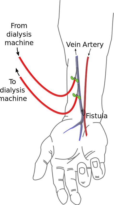 Fistula Surgery, Vascular Ultrasound, Interventional Radiology, Nurse Midwife, Decisions Decisions, Medical School Essentials, Medical Coding, Nursing Education, Nursing Notes