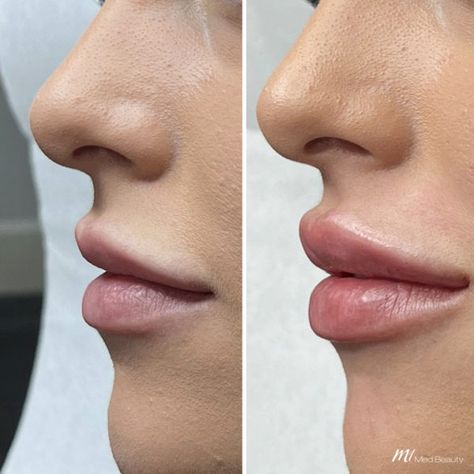 Hip Filler, Natural Lip Fillers, Lip Fillers Juvederm, Natural Filler, Lip Surgery, Lips Inspiration, Dairy Free Breastfeeding, Botox Lips, Facial Contouring