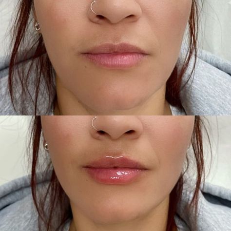 Nurse Marianne on Instagram: "Mini lip plump for my beautiful client 🪄 💋 👩🏽‍⚕️ Procedure: Non-surgical lip augmentation 🗓 Duration: 6-12 Months on average 💰 Cost: $449-$549 a syringe ⏱ Recovery: Immediate redness, bruising and/or swelling can be present after injections and will subside over the next few hours to days but can take up to 4 weeks to fully heal and settle in Afercare: 🧊 Apply ice to reduce swelling 🏋🏽‍♀️Avoid strenuous exercise for 24 hours 🥂 Avoid alcohol for 24-48 hours Full Syringe Lip Filler, Key Hole Lips Injections, Light Lip Injections, Mini Lip Plump Before And After, Mini Lip Filler, Lip Augmentation Before And After, Lip Injections Before And After 1ml, Half Syringe Lip Filler, Half Syringe Lip Filler Before And After