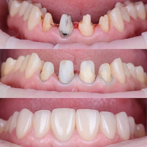 DENTISTRY SCIENCE on Instagram‎: "Build up - 3M Fiber Post+Bulk Fill. Ceramic crowns e.max. . By @stomatolog_31 . . . * ・・・ #dxb #dubai #dental_clinic #cosmeticdentistry #dentoart_worldwide #dentalphotography #luxury #esthetician #compositeveneers #hollywoodsmile #cosmeticdentistry #veneers #directcomposite #dentalart #dentistryworld #dentistrylove #dentaloffice #dentistica #dentalphotography #dentaltechnician #dentalhygienist #dentisteylife #composite #compositeveneers ‏#smiledesign #c Luxury Esthetician, Dental Crown Procedure, Dental Ceramics, Esthetic Dentistry, Tooth Filling, Dental Posts, Dental Aesthetics, Dental Photography, Dental Implants Cost