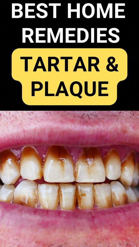 8 Natural Ways to Remove Tartar from Your Teeth#plaqueremoval #plaqueremovalathome #tartarremoval #gettingridoftartaronteeth #tartarandplaqueremovalhomeremedies #WhyIsOralCareSoImportant Plaque Removal At Home, Tartar Removal, Tooth Decay Remedies, Dental Cavities, Tooth Sensitivity, Oral Care Routine, Gum Care, Receding Gums, Natural Teeth