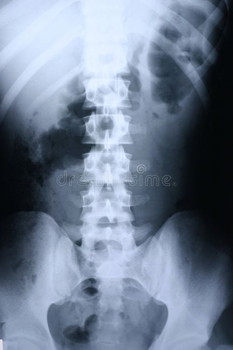 Xray/spine 1 , #AD, #Xray, #spine #ad Spine Xray, Weird Xrays, Rib Cage Xray, Lumbar Spine Xray Anatomy, X-ray Images Radiology, X Ray, Stock Photography Free, Anatomy, Health Care