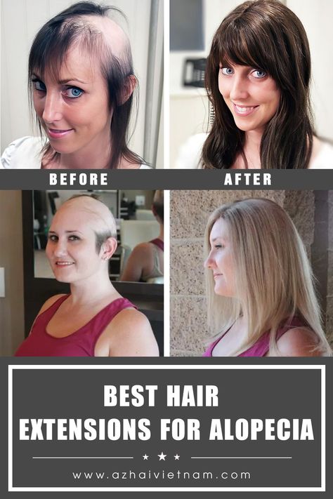 We have received a lot of questions as well as plaintive related to hair problems, specially Alopecia. So to answer all these questions about hair extensions for Alopecia, in this blog, we’ll give you the list of the best hair extensions for Alopecia to help you become more confident without worrying about your hair situation anymore. Hair Extensions After Chemo, Alopecia Hairstyles, Best Hair Extensions, Become More Confident, Hair Company, Bald Hair, Hair Extentions, Hair Extensions Best, Best Wigs