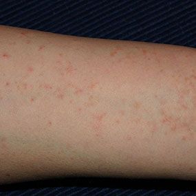 Scabies: The Seven-Year-Itch Skin Rashes Pictures, Stomach Ache Remedy, Remove Skin Tags Naturally, Itchy Rash, Bed Bug Bites, Bed Bug, Natural Antibiotics, Bug Bites, Skin Allergies