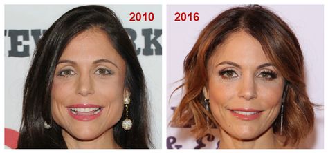 bethenny frankel before and after botox injections to jaw for tmj..botox changes jaw shape Tmj Botox Before And After, Botox Brow Lift, Cosmetic Dentistry Veneers, Botox Before And After, Botox Lips, Botox Cosmetic, Teeth Whitening Remedies, Bethenny Frankel, At Home Hair Removal