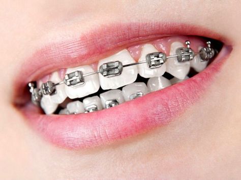 I wore silver bands on my silver braces so that colors didn't exaggerate my braces. Black Braces Teeth, Orthodontics Marketing, White Braces, Silver Braces, Kawat Gigi, After Braces, Braces Bands, Black Braces, Cute Braces Colors