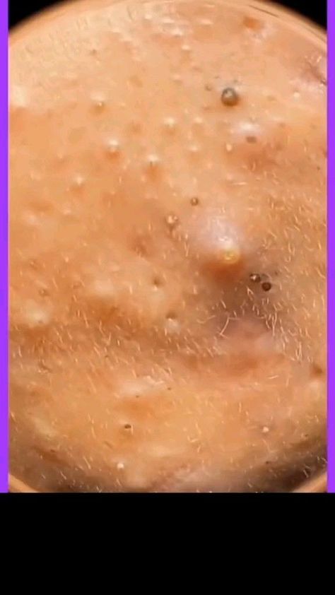 Blackheads Removal | Blackheads Removal Satisfying Videos | Blackheads Removal Homemade | Blackheads Removal Video Black Heads | Blackheads Removal Youtube | Blackheads Removal Diy | Blackheads Removal Video | Blackheads Removal Cream | Blackheads Removal Satisfying Videos Spa Clean Pores Videos, Best Dark Spot Remover, Pore Extraction, Pimple Extraction, Clear Blackheads, Blackhead Extraction, Black Head Remover Mask, Zit Popping Videos, Acne Help