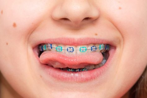 Ultimate Guide to Braces for Kids - Best Dental Care for Kids Colored Braces, Tooth Aesthetic, Braces For Kids, Braces Colours, Straighten Teeth, Lingual Braces, Ceramic Braces, Braces Cost, Dental Care For Kids