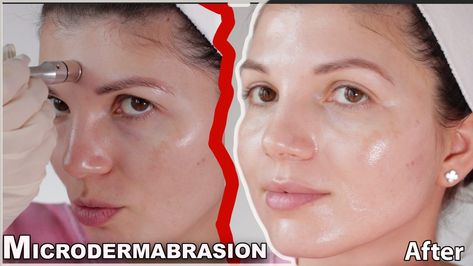 Microdermabrasion at Home: Everything you Need to Know - Ray Cochrane Microdermabrasion At Home, Microdermabrasion Benefits, Collagen Injections, Microdermabrasion Facial, Foundation Routine, Microdermabrasion Machine, Deep Exfoliation, Brighter Skin, Facial Rejuvenation