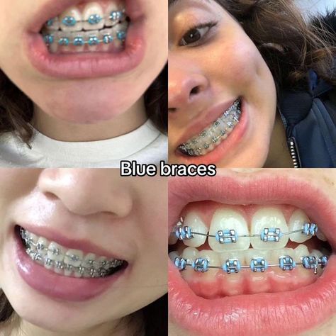 Braces Sky Blue, Blue Braces Aesthetic, Braces Inspo Aesthetic, Blue Braces Colors, Pink And Blue Braces, Braces Colors For Brunettes, Brace Colors Ideas, Periwinkle Braces, Braces Aesthetic Colors