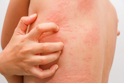 High Histamine Foods, Tomato Nutrition, Mast Cell Activation Syndrome, Zinc Deficiency, Mast Cell, Skin Allergies, Insect Bites, Poison Ivy, Home Remedies