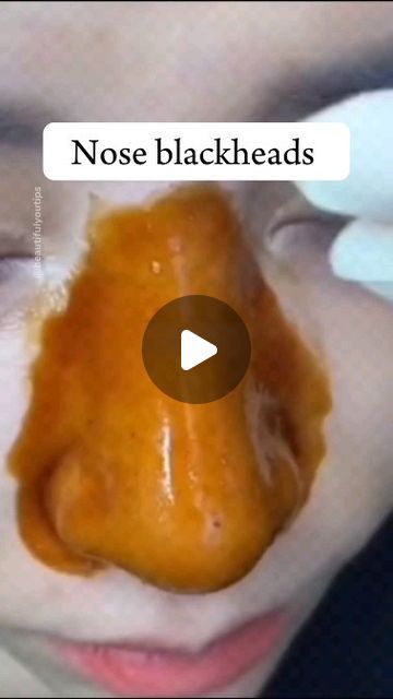 HomeBeautyHack on Instagram: "Nose Blackheads/Whiteheads Gai removal in 1 one day with this easy DIY mask| if you have lots of blackheads and whiteheads issue on your nose and cheek area so try this.
.
.
Repeat every week..
.
.
Follow for more .
.
.
.
.cc👉@beautifulyoutips❤️
#skincare #skincareroutine #blackheads #whiteheads #acne #reels" Satisfying Black Head Removal Video, Remove Blackheads From Nose, Black Head Removal Video Nose, Blackheads And Whiteheads, How To Treat Blackheads, Blackhead Remover Diy, Blackheads On Face, Blackhead Remedies, Nose Blackheads