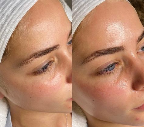 Facials Before And After, Microneedling Before And After, Dermaplaning Before And After, Hydrafacial Before And After, Derma Planing, Facial Before And After, Dermaplaning Facial, Diy Facials, Deep Clean Skin