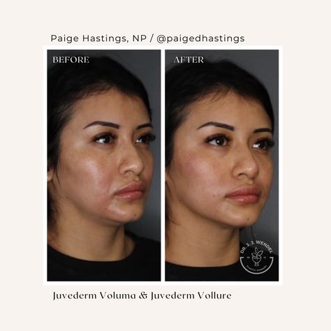 Nasolabial Folds Filler, Nasal Labial Folds Before And After, Kybella Before And After, Nasolabial Folds Dermal Fillers, Deep Nasolabial, Nasolabial Fold Filler, Microneedling With Prp, Juvederm Voluma, Laser Skin Resurfacing