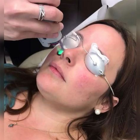 Skin care is one of the most important aspects of preserving one’s appearance.  🥰🥰🥰 #wbo #womensbeautyoffers #beautybllogers #beautyfashion #fashion #fractional #restoringskin #skin #sharplight Profractional Laser, Face Laser, Acne Scaring, Acne Laser, Face Treatments, Laser Skin Resurfacing, Fractional Laser, Laser Resurfacing, Skin Resurfacing