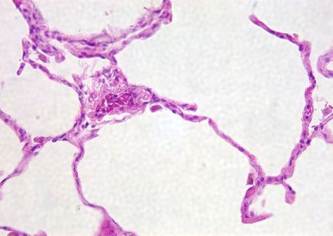 SIMPLE SQUAMOUS EPITHELIUM. lots of open space, again looks like thick drawn lines. look for nuclei. distinguish from super zoomed in adipose but the thickness of lines and dark spots(nuclei) Simple Squamous Epithelium, Squamous Epithelium, Anatomy And Physiology Histology, Transitional Epithelium Histology, Connective Tissue Histology, Small Intestine Histology, Histology Slides, Female Genital System Histology, Biology Facts