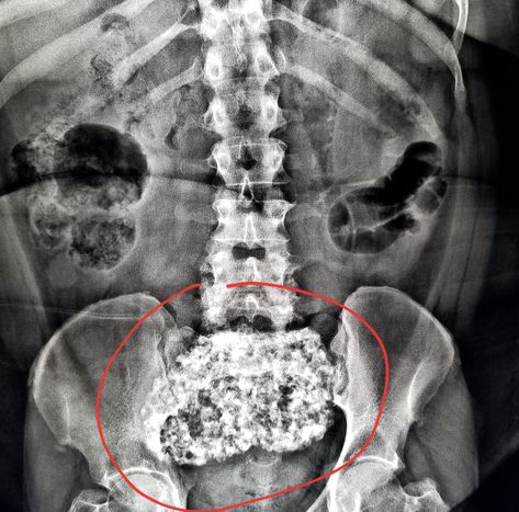 #Abdomen #xray: large #fibroid with #calcifications in patient with #belly #pain. #radiologist #radiology Hip Xray Anatomy, Ribs X Ray Anatomy, Normal Chest Xray, Fluoroscopy Radiology, Chest X Ray Radiology, Radiology Imaging, Xray Tech, Radiology, Scary Art