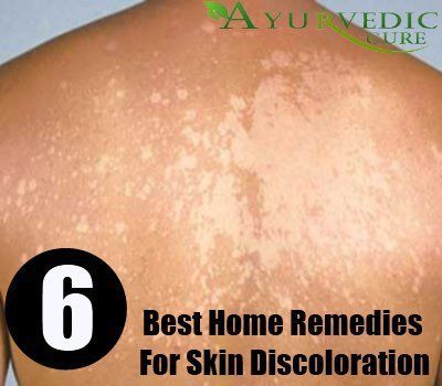 Skin Discoloration Sagging Skin Remedies, Skin Peeling On Face, Remedies For Skin, Home Remedies For Skin, Dry Skin Remedies, Home Remedies For Acne, Skin Disorders, Peeling Skin, Acne Remedies