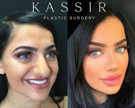 Facial Plastic Surgery Before After, Blephoraplasty Before And After, Dimple Surgery, Ethnic Rhinoplasty, Plastic Surgery Gone Wrong, Rhinoplasty Before And After, Celebrity Plastic Surgery, Neck Lift, Bath And Body Works Perfume