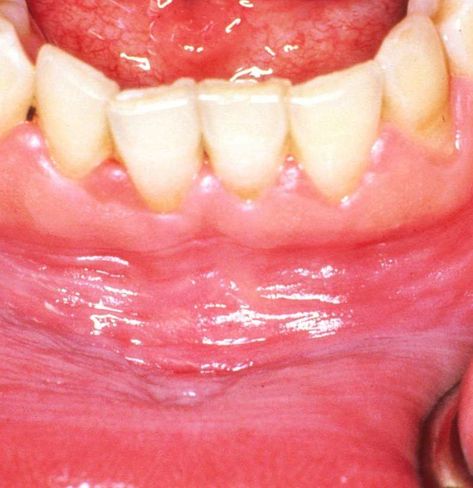 Gum Inflammation, Mouth Rinse, Canker Sore, Periodontal Disease, Gum Health, Nutritional Deficiencies, Balanced Diet, Oral Health, Home Remedies