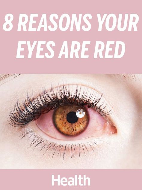 Red Veins In Eyes, What Causes Red Eyes, Frankincense Oil Uses, Bloodshot Eyes, Calendula Benefits, Coconut Health Benefits, Sore Eyes, Red Patch, Benefits Of Coconut Oil