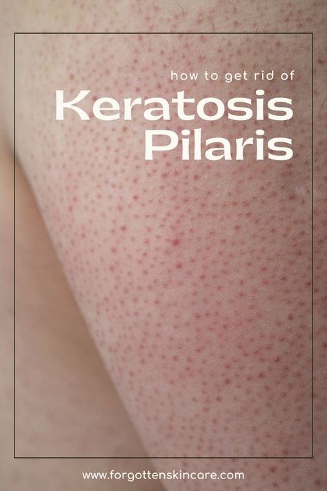 keratosis pilaris, remedy, treatment, on face, diet, tattoo, kids, face, before and after, on bottocks Chicken Skin Remedy, Keratosis Pilaris On Face, Pilaris Keratosis, Keratosis Pilaris Remedy, Natural Nail Care, Skincare Products Photography, Skin Growths, Clear Healthy Skin, Diy Skin Care Routine