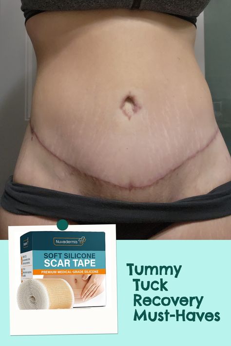 Ready to bounce back after your tummy tuck?👩‍👩‍👧‍👦 Discover the top recovery essentials you absolutely need to make the process more comfortable and stress-free. Check out our comprehensive list now!🎁 Plus Size Tummy Tucks Before And After, Tummy Tucks Recovery Tips, Mommy Makeover Recovery, Mommy Makeover Surgery Recovery, Tummy Tucks Recovery, Mommy Makeover Surgery, Amazon List, Mommy Makeover, Bounce Back