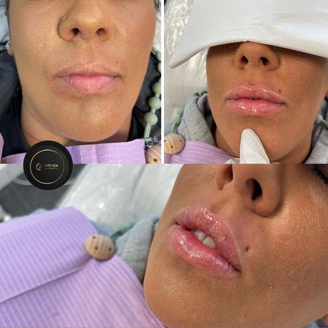 Lip Filler for virgin lips 👄 Such a big diffrence 😍 🌸What is important when considering having your lips done? « Everyone’s lips are anatomically different so please do not fall victim to pretty pictures and think you can have exactly the same shape or volume, everything is very indivudual! 🌼Lips fillers are not permanent! Your body naturally dissolves the filler over time! 💉Hyaluronic acid which is the primary ingredient of the fillers is present in our bodies naturally 💉Lips fillers are... Lips Fillers, Lip Filler, Lip Fillers, Your Lips, Our Body, Pretty Pictures, Hyaluronic Acid, Lips, Quick Saves