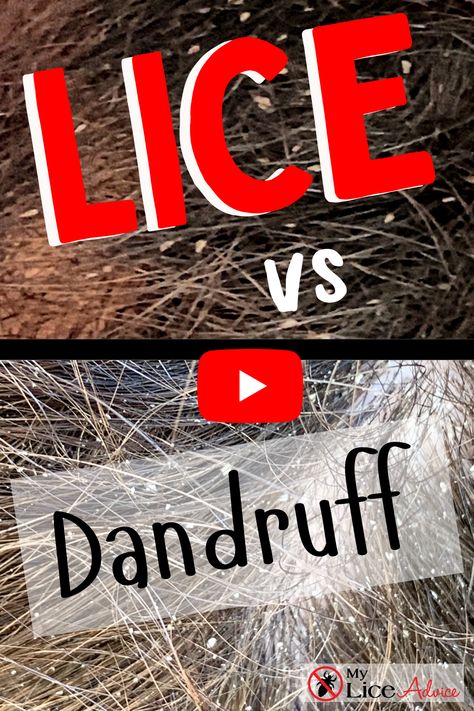 Lice eggs and dandruff are easily mistaken for one another. In this video tutorial, look at side-by-side pictures and videos, and you can easily see the difference between lice and dandruff. Both lice and dandruff can leave your head itching, so how are you supposed to know which is which? This foolproof guide, loaded with side-by-side pictures, will show you exactly how to tell the difference between lice and dandruff. #myliceadvice #licevsdandruff #lice Lice Remedies How To Get Rid Of Home, How To Get Rid Of Lice And Nits Fast, Lice Removal Videos, Dandruff In Kids, Lice In Hair, Lice Pictures, Itchy Head, Itchy Scalp Remedy, How To Treat Lice