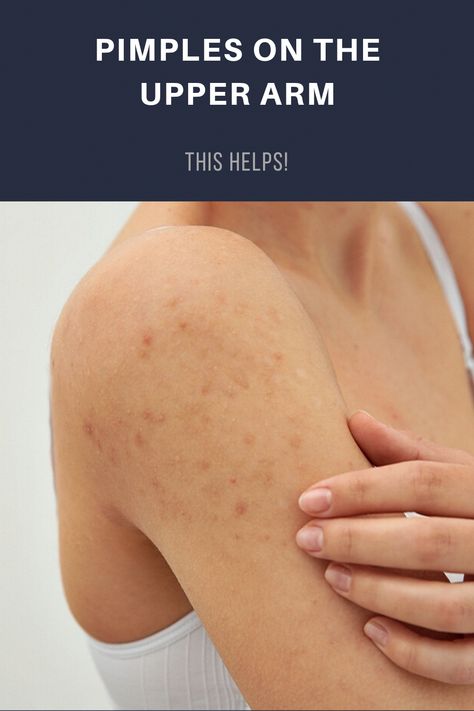 Where did they come from? Pimples on the upper arm may not be a disaster, but they're not welcome either. You can get rid of them that way! Remove Skin Tags Naturally, Get Rid Of Pimples, Blind Pimple, Rid Of Pimples, Forehead Acne, Pimples Under The Skin, Prevent Pimples, Underarm Hair Removal, Natural Acne Remedies