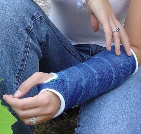 arm in a cast Girl In Hospital, Broken Arm Cast, Long Leg Cast, Arm Cast, Broken Ankle, Printed Tape, Leg Cast, Casting Kit, Baby Tumblr